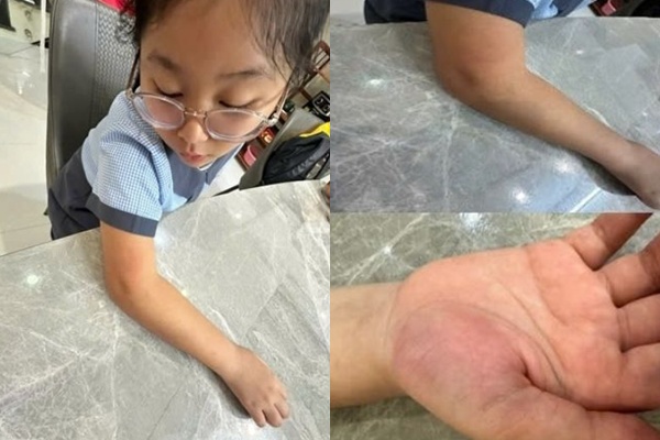 Học sinh bị cô giáo phang g.ãy tay vì quên mang vở: “Cháu từng phải ph:ẫu thu:ật, b:ắn vít nên tay rất yếu, giờ bị cô làm thế này s.ợ khó hồi phục”